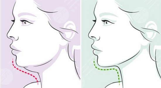 如何減去雙下巴