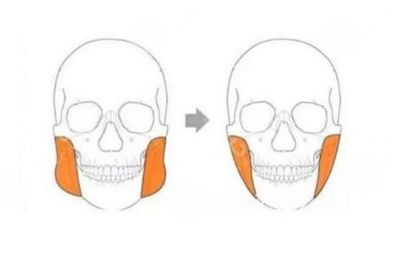 磨骨手術(shù)后的注意事項(xiàng)