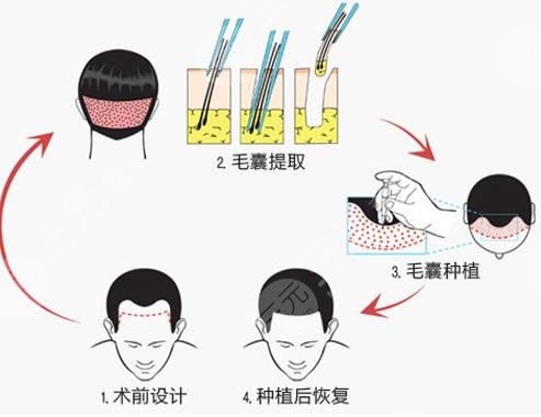 禿頂植發(fā)手術(shù)案例