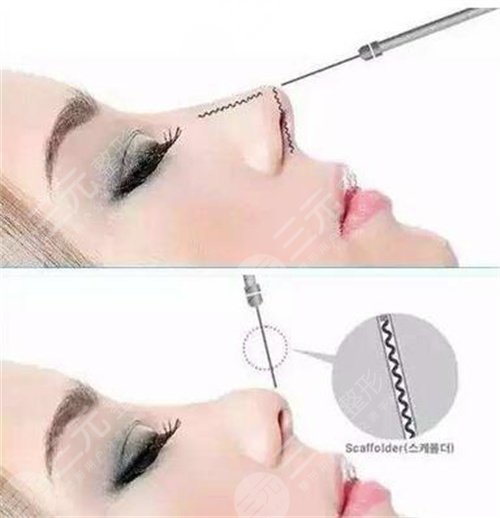 如何能讓自己的鼻子變高變挺 鼻子整形手術(shù)會(huì)有什么后遺癥 鼻子整形手術(shù)的后遺癥有哪些是什么