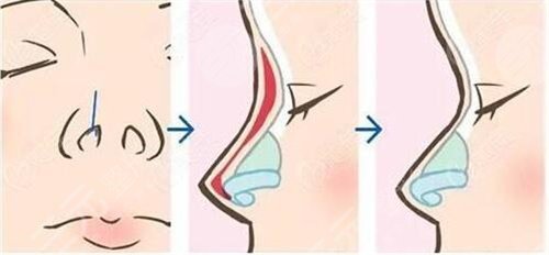 如何能讓自己的鼻子變高變挺 鼻子整形手術(shù)會(huì)有什么后遺癥 鼻子整形手術(shù)的后遺癥有哪些是什么