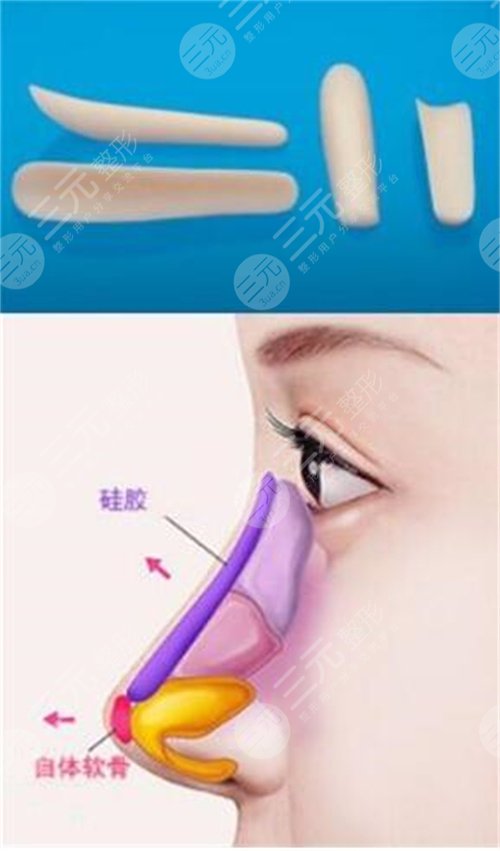 如何能讓自己的鼻子變高變挺 鼻子整形手術(shù)會(huì)有什么后遺癥 鼻子整形手術(shù)的后遺癥有哪些是什么