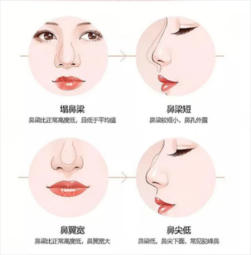 如何能讓自己的鼻子變高變挺 鼻子整形手術(shù)會(huì)有什么后遺癥 鼻子整形手術(shù)的后遺癥有哪些是什么