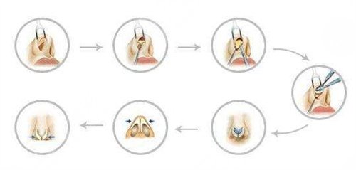 鼻翼缺損矯正手術(shù)會留疤嗎？