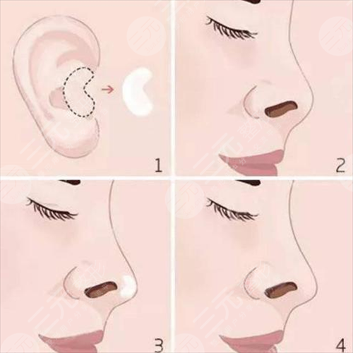 自體軟骨隆鼻注意事項(xiàng)有哪些