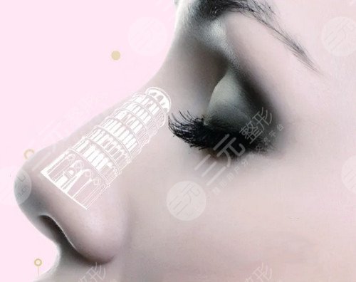 自體軟骨隆鼻術(shù)后后遺癥