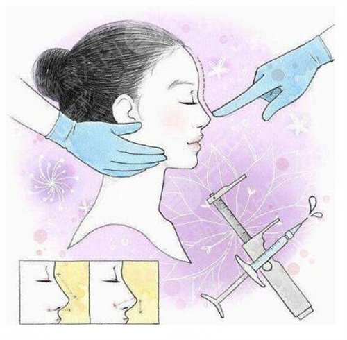 朝天短鼻整形手術(shù)原理