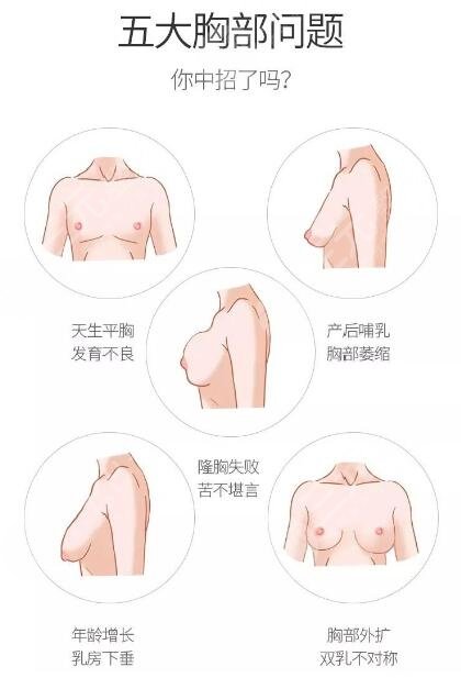 副乳手術(shù)多少錢