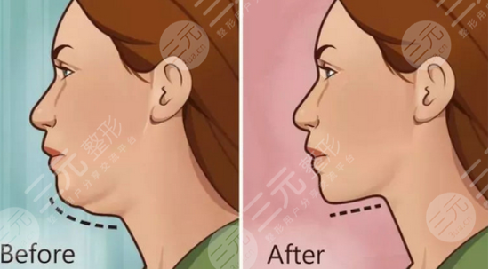 光纖溶脂和吸脂的區(qū)別