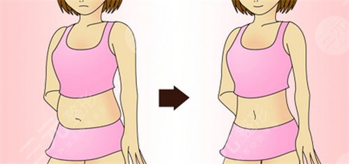 腹部吸脂減肥成好嗎 腹部吸脂減肥會(huì)反彈嗎