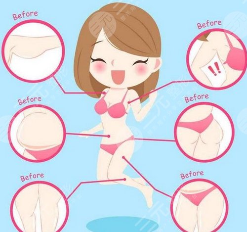 腹部吸脂減肥成好嗎 腹部吸脂減肥會(huì)反彈嗎