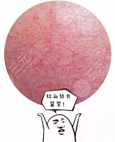 臉上紅血絲是身體出了問(wèn)題嗎
