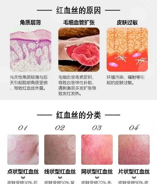 紅血絲應(yīng)該怎樣預(yù)防