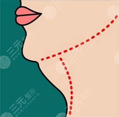 光纖溶脂瘦臉恢復過程圖