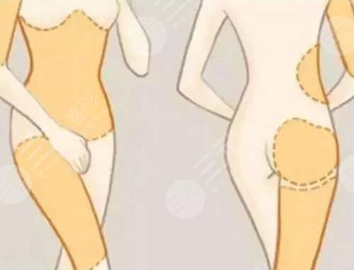 打注射瘦腿多少錢？多少錢一針比較合適？