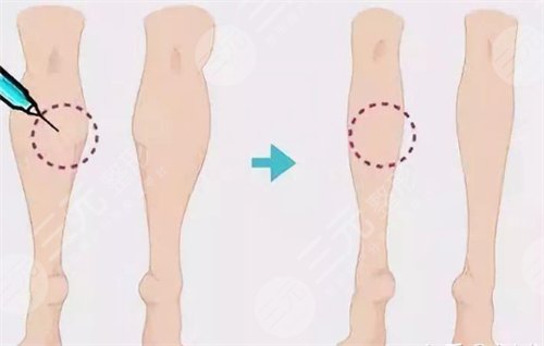 注射瘦腿有嗎 注射注射瘦腿前后對(duì)比圖