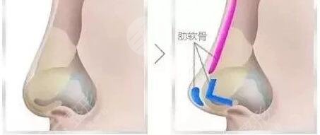 隆鼻術(shù)后第七天