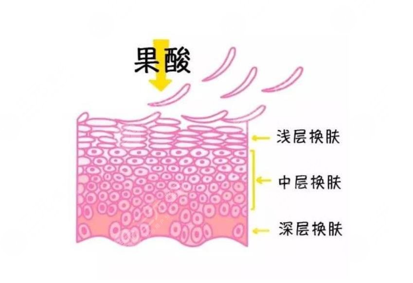 祛痘有方法|3個小妙招分享