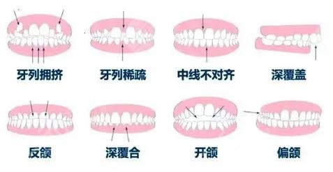 牙齒矯正適應(yīng)癥