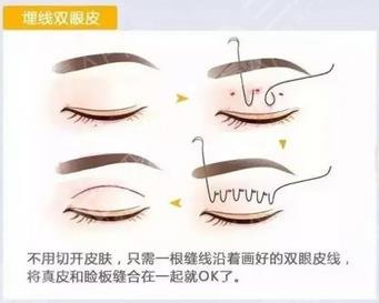 雙眼皮手術過程