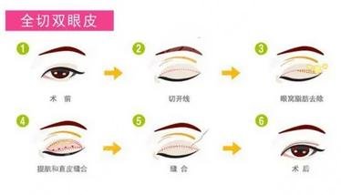 全切雙眼皮手術(shù)