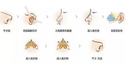 隆鼻過程