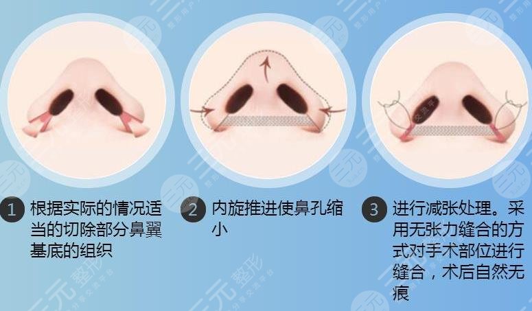 怎么使鼻子變小?