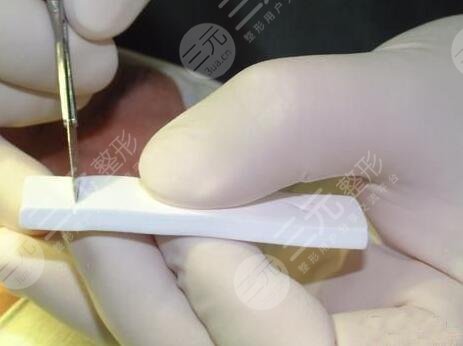 隆鼻前后對(duì)比果圖片