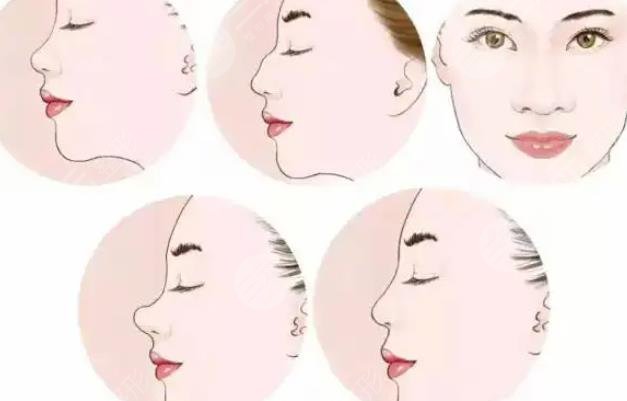 肋骨隆鼻三個月變化圖、手術前