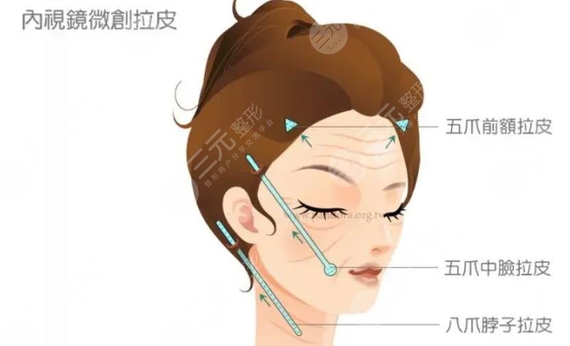 美容拉皮手術(shù)需要多少錢呢