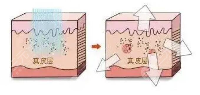 點陣激光后恢復原理