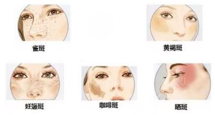 激光祛斑之后的護理措施有哪些呢?