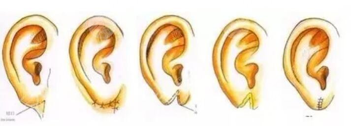 杯狀耳整形