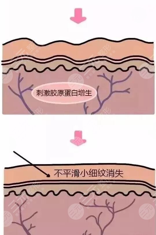 不同的操作員影響力冰電波拉皮的價(jià)格