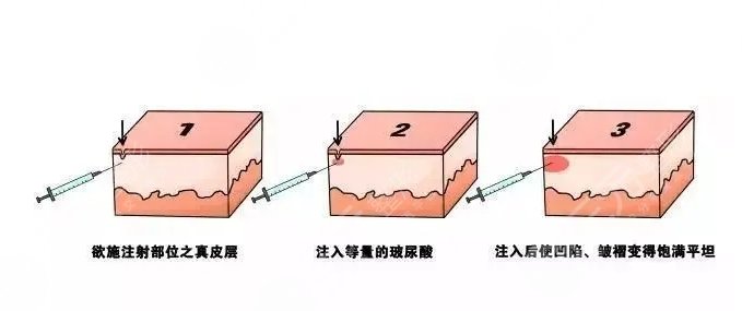 玻尿酸填充法令紋多少錢
