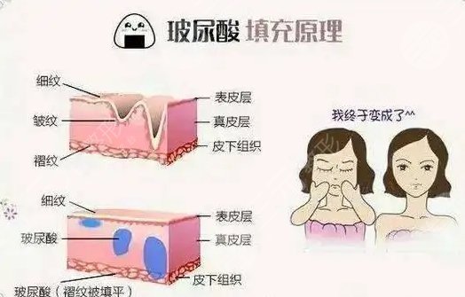 玻尿酸填充法令紋多少錢