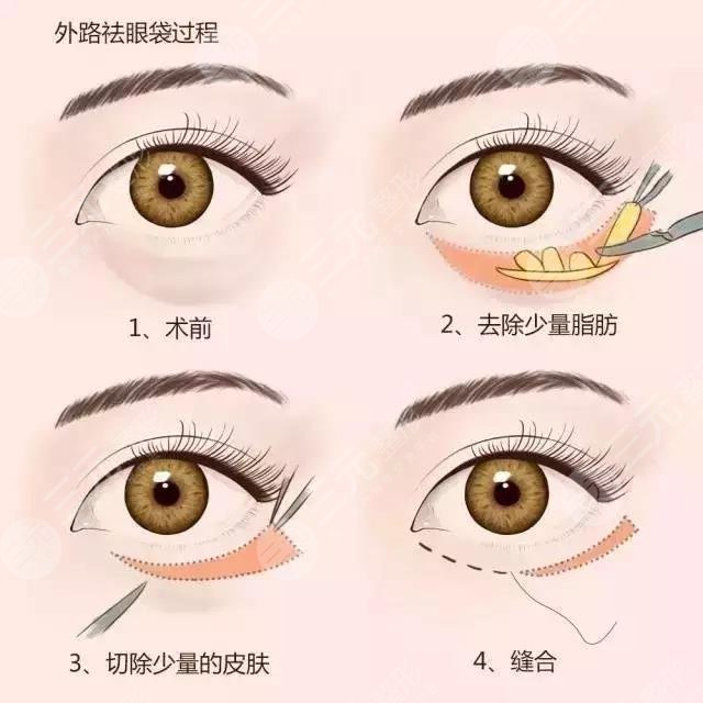 內(nèi)切去眼袋能保持多久?