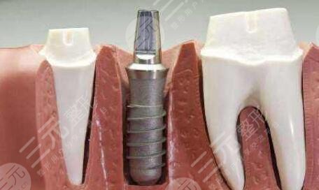 種植牙