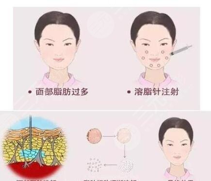 全臉脂肪填充術(shù)后注意事項