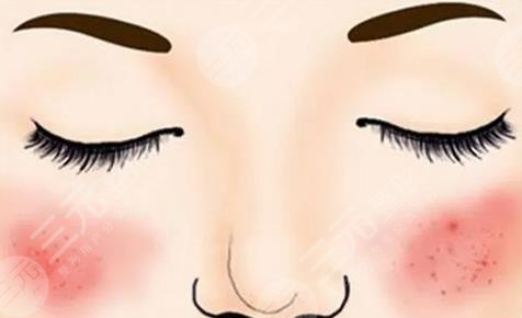 激光紅血絲后多久恢復(fù)？會傷皮膚嗎？