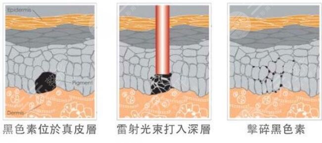 彩光祛斑術(shù)后怎么護(hù)理?