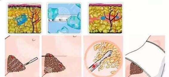 腹部吸脂減肥價格如何？