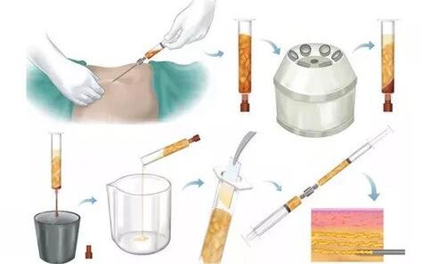 腹部吸脂減肥手術(shù)的原理