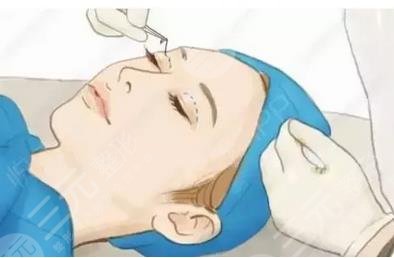泰安附屬醫(yī)院美容科埋線雙眼皮案例分享