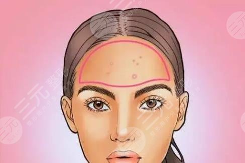 額頭長痘