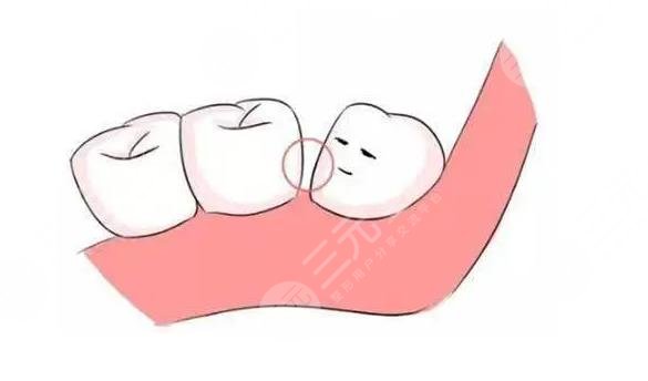 牙縫怎么修補(bǔ)