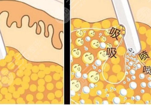 自體脂肪豐蘋果肌果好嗎?