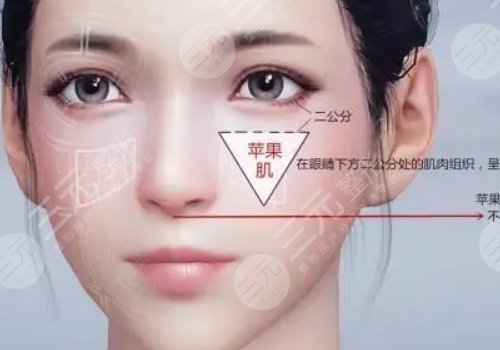 自體脂肪豐蘋果肌果好嗎?