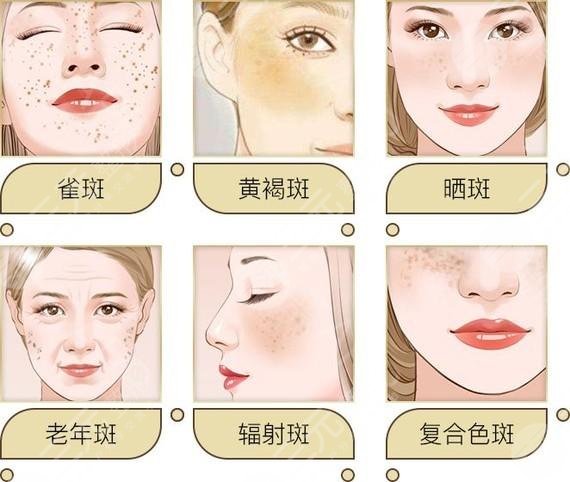 如何有祛斑不反彈?