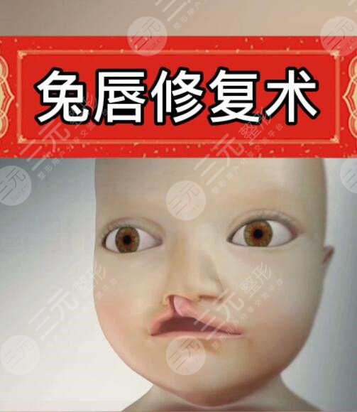 唇腭裂手術(shù)